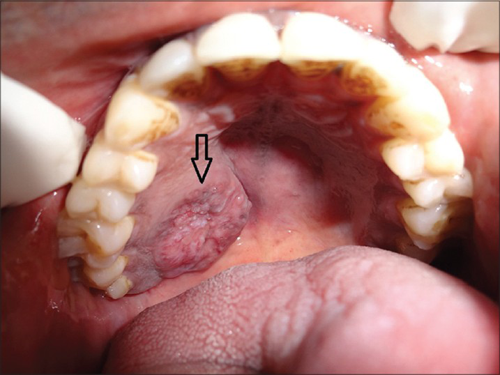 45-year-old male patient with lesion on the right side of the palate diagnosed as mucoepidermoid carcinoma – intermediate stage. Intra-oral photograph shows the ulcerated lesion on the right upper palate (arrow).